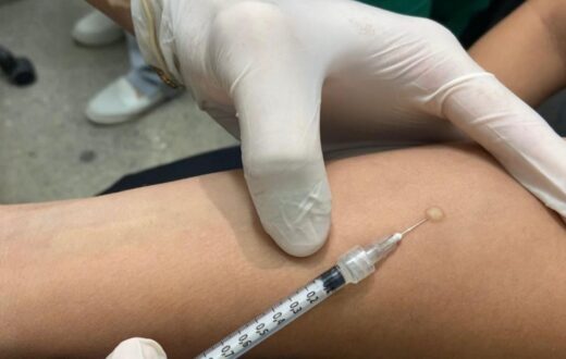 Após reação no PPD, avaliação clínica define indicação de tratamento preventivo em Manaus