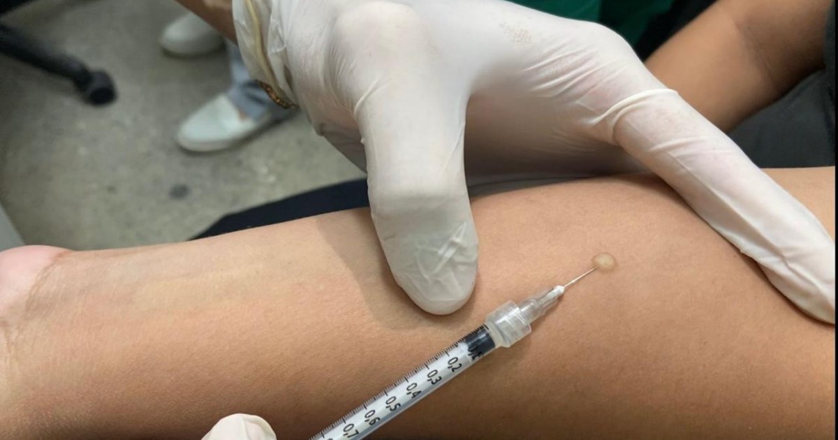 Após reação no PPD, avaliação clínica define indicação de tratamento preventivo em Manaus